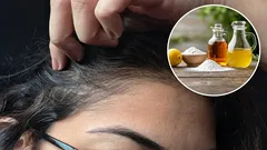 Aké sú výhody používania octu a jedlej sódy na odstránenie šedín a ako to robiť správne?